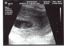 scan of the baby